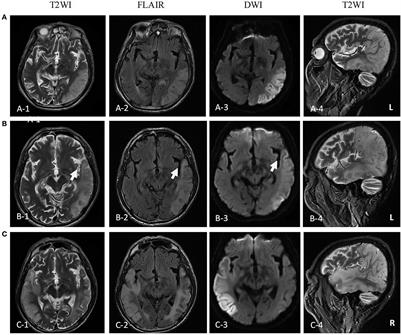 Frontiers Elderly Onset Of Melas In A Male A Case Report